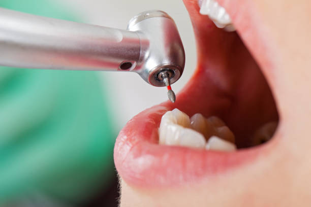 Best Dentist for Tooth Abscess  in Walnut Creek, CA